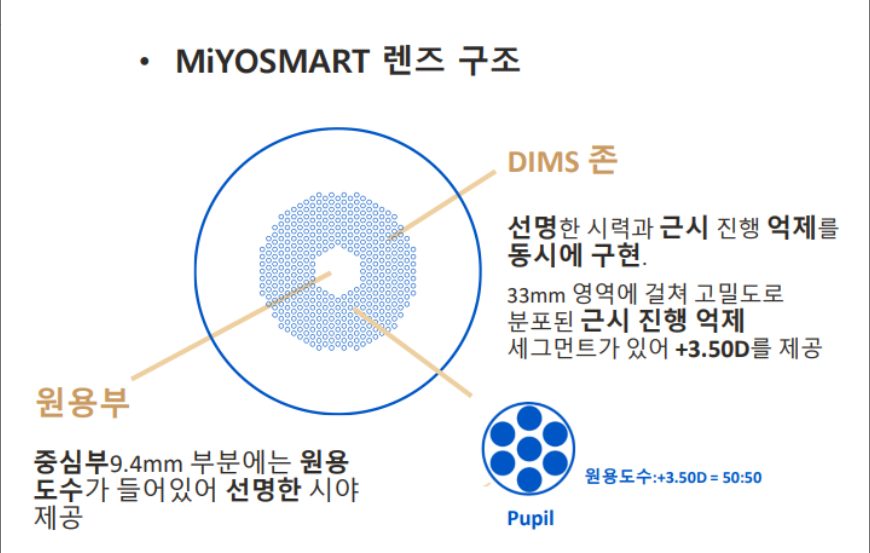 마이오스마트 렌즈 구조: 중심부 원용부와 DIMS 존